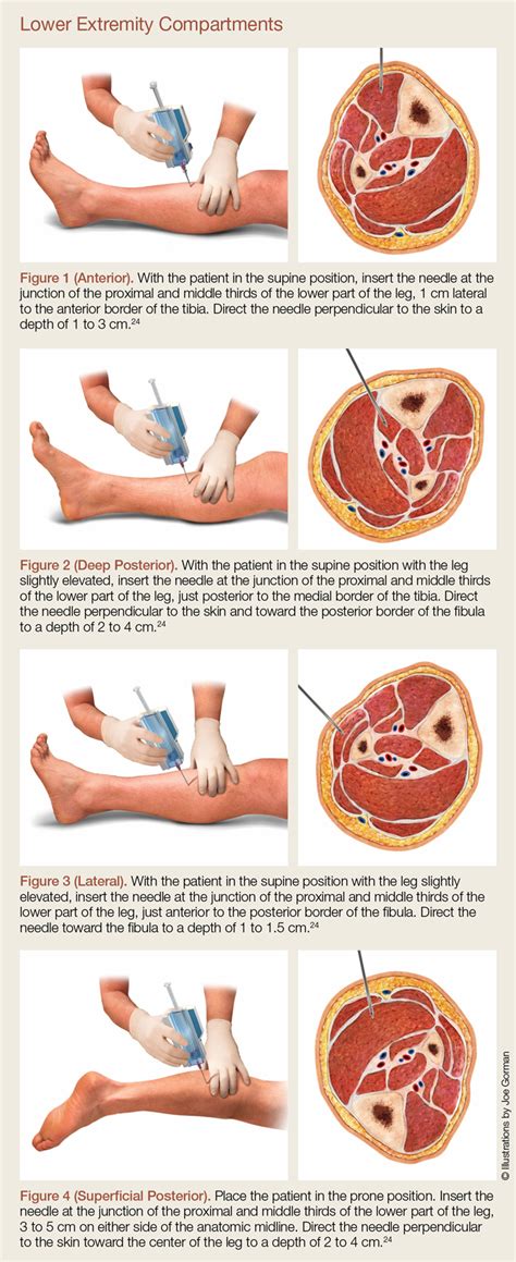 Acute Exertional Compartment Syndrome Captions More Vrogue Co