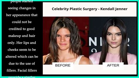 Kendall Jenner Plastic Surgery Before And After Then And Now Youtube