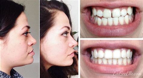 Pin On Braces Before And After