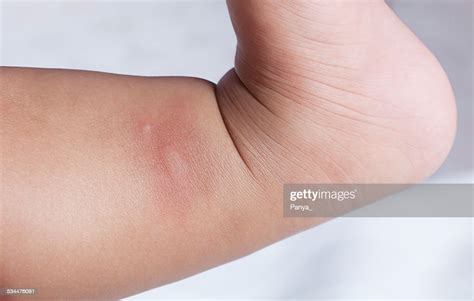 New Born With Multiple Mosquito Bites On Arm High Res Stock Photo