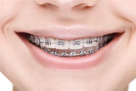Your Visual Guide To Different Types Of Braces Langley Braces Aura Orthodontics