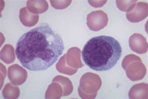 The Gallery For Atypical Lymphocytes Vs Monocytes