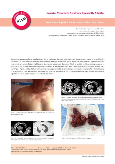 Pdf Superior Vena Cava Syndrome Caused By A Goiter