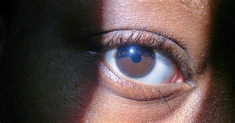 Blue Ring Around Eye Pictures Causes And Treatment