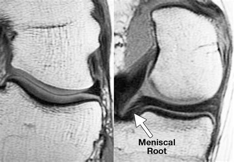 Mr Imagingbased Diagnosis And Classification Of Meniscal Tears Radiographics