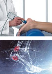 Extracorporeal Pulse Activation Technology Epat Shockwave Therapy