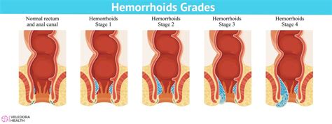 Hemorrhoids Causes Symptoms And Treatment