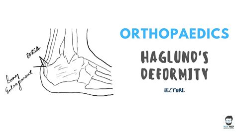 Haglund Deformity Orthopaedics Detailed Explanation Youtube