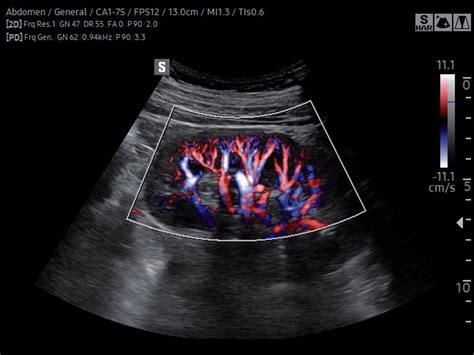 Ultrasound Images • Kidney S Flow Echogramm №816