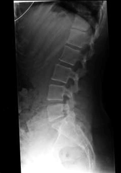 Anterior Spinal Column Reconstruction Anterior Lateral And Oblique