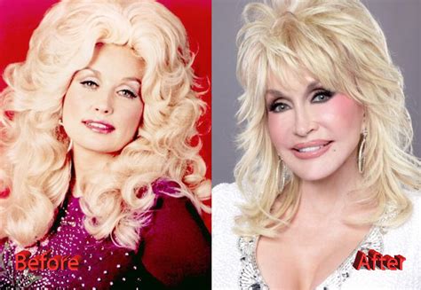 Dolly Parton Plastic Surgery Gracefully Getting Old Or Not Plastic