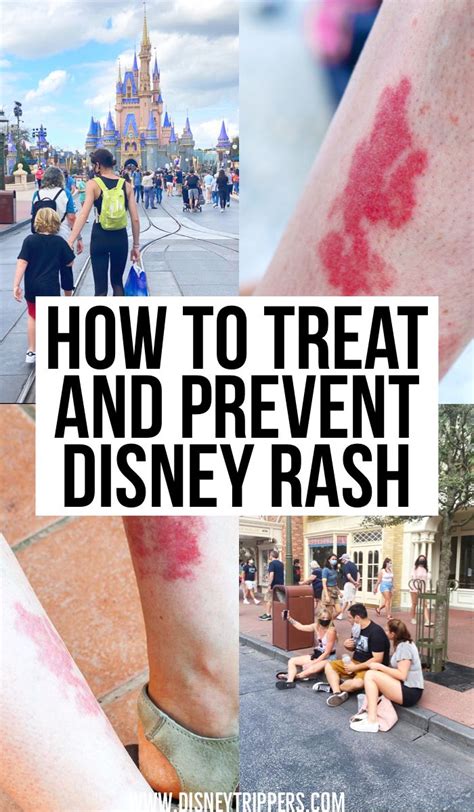 How To Treat And Prevent Disneys Rash On The Leg Right Before They