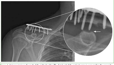 Figure 1 From Erosion Of The Coracoid Process After Distal Clavicle