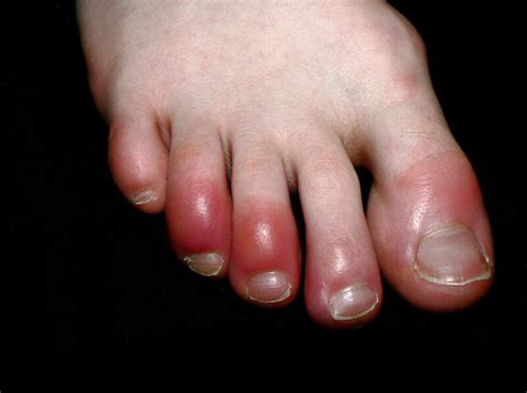 From Loss Of Smell To ‘covid Toes What Experts Are Learning About