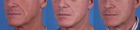 Patient 122406414 Nasolabial Folds Before And After Photos Clevens