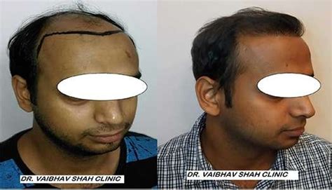 Which Is Best Hair Transplant Clinic In Mumbai Quora
