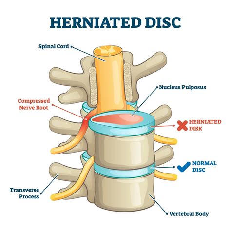 L4 L5 Disc Herniation Explained Premia Spine