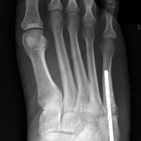 4 Type Of Fifth Metatarsal Fracture