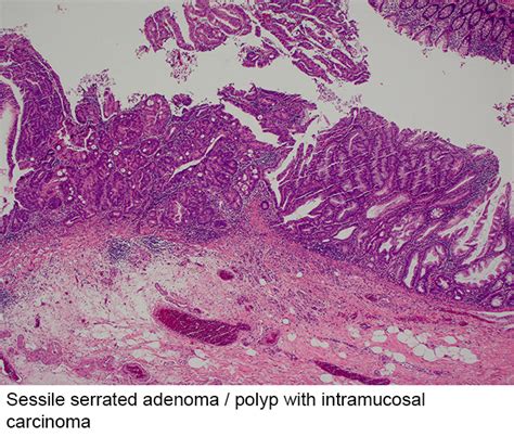 Pathology Outlines Sessile Serrated Adenoma