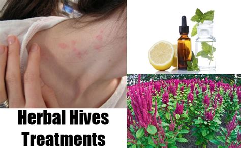 Herbal Hives Treatments Natural Home Remedies And Supplements