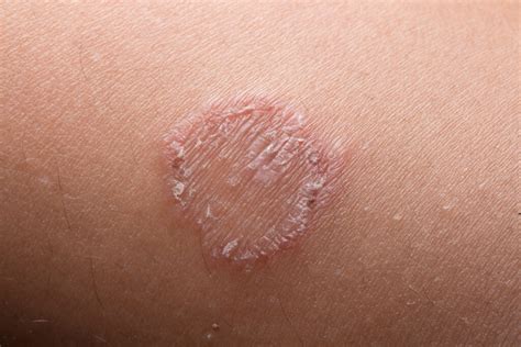 Ringworm Causes Symptoms Preventions