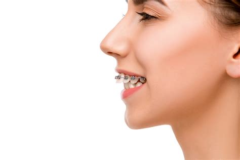 What Is An Overbite And How Can It Be Fixed Dental Health