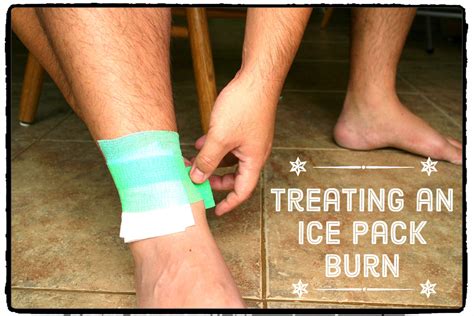 How To Treat A Cold Pack Burn Remedygrove