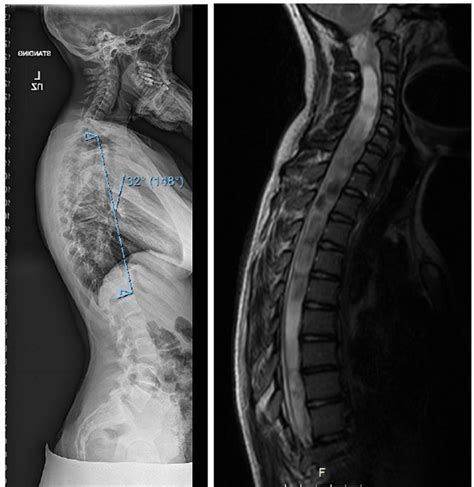 Abnormal Thoracic Spine Mri