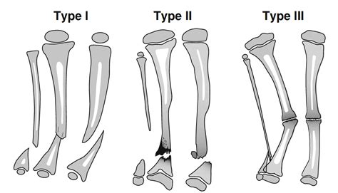 Congenital Pseudarthrosis Of The Tibia Paley Orthopedic And Spine Institute