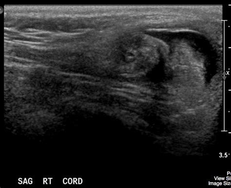 Testicular Torsion Undergraduate Diagnostic Imaging Fundamentals