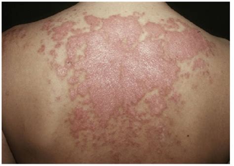 Cutaneous Lupus Erythematosus An Overview Mdedge Dermatology