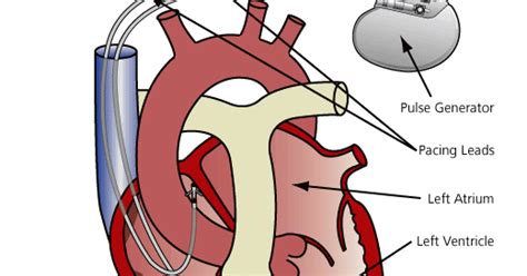 Doctors Gates Cardiac Pacemaker