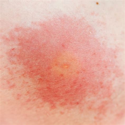 19 Common Bug Bite Pictures How To Id Insect Bites And Stings