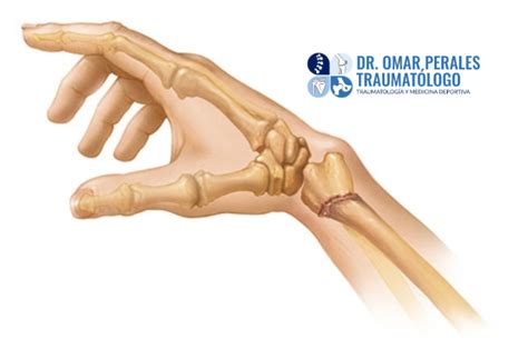 Fractura De Radio Distal Dr Perales Traumat Logo