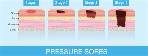 Pressure Ulcer Staging Guide