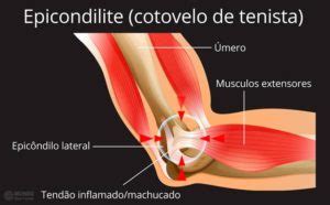 Dor No Cotovelo Principais Causas O Que Fazer E Como Prevenir