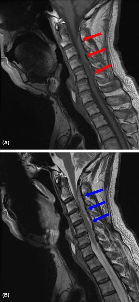 Spontaneous Cervical Epidural Hematoma Mimicking A Transient Ischemic