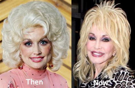 Dolly Parton Plastic Surgery Before And After Photos Latest Plastic