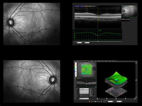 Optical Coherence Tomography Oct Tower Clock Eye Center