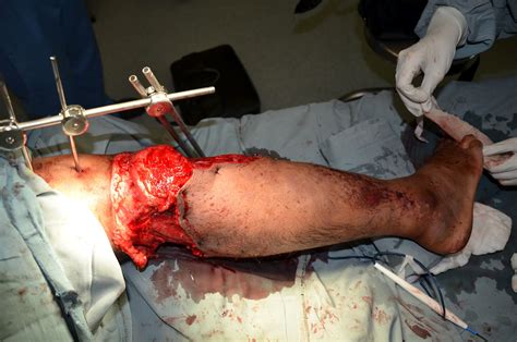 MAJOR CIRCUMFERNTIAL DEGLOVING INJURY - Gross instability fo the knee ...