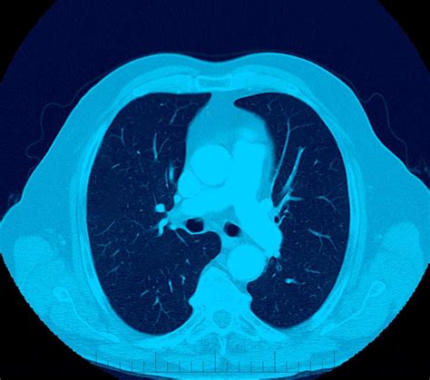Ultra Low Dose CT Scan Diagnostic Imaging Melbourne Radiology