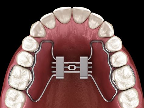 Ways To Treat A Misaligned Jaw Ahava Orthodontics