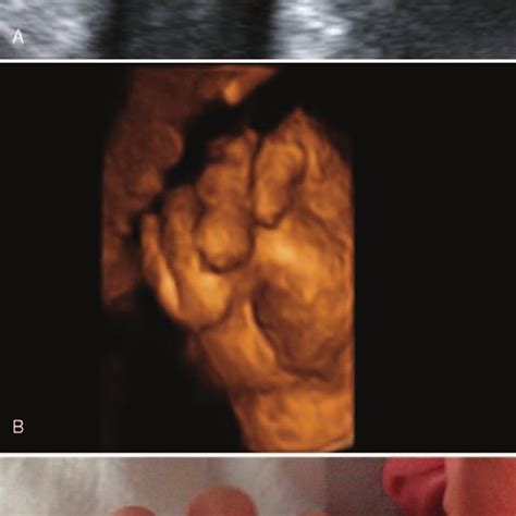 Pdf Adducted Thumb As An Isolated Morphologic Finding An Early