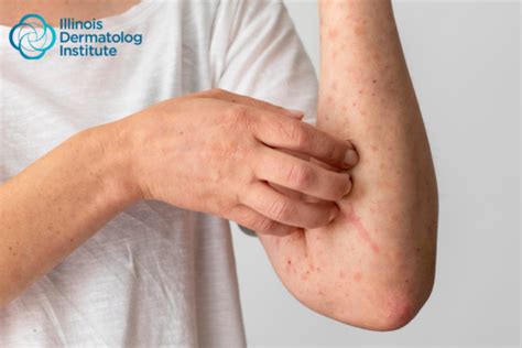 Common Skin Rashes Causes Symptoms And Treatment Idi