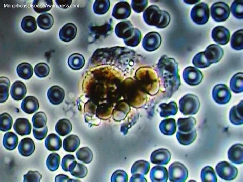 Morgellons Disease Awareness - Live blood microscopy in a ...