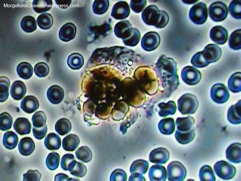 Mayo clinic employees suggest getting loads of relaxation and take ache relievers to reduce the discomfort. Morgellons Disease Awareness - Live blood microscopy in a person suffering from Morgellons ...