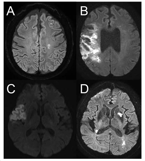 Neuroimaging Patterns Of Embolic Stroke Of Undetermined Source A