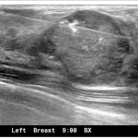 A 25 Year Old Female With Dcis In Fibroadenoma Ultrasound Guided