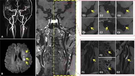 Mri Study Reveals Arterial Culprit Plaque Characteristics Chinese
