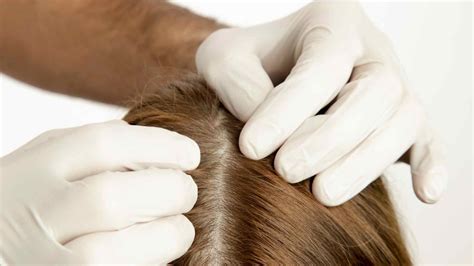 Scalp Folliculitis Causes Symptoms Treatments And Prevention